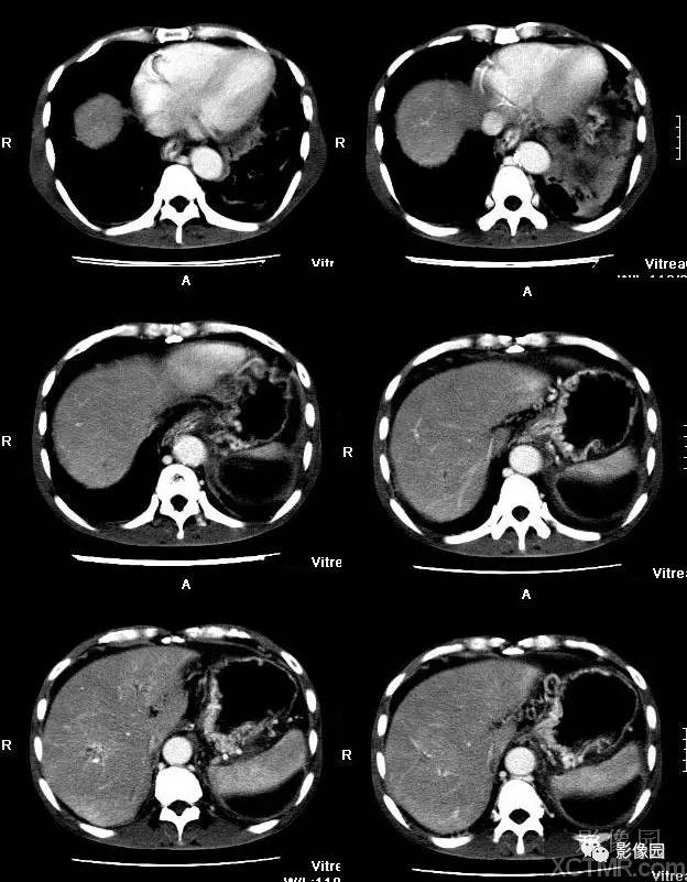 【病例】胰腺假性囊肿并囊内假性动脉瘤形成1例CT 【病例】胰腺假性囊肿并囊内假性动脉瘤形成1例CT