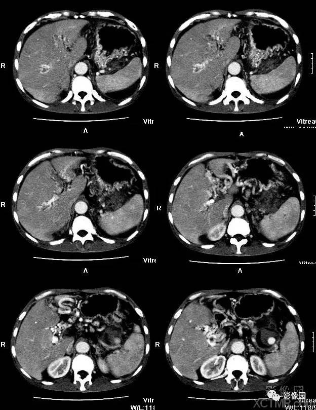 【病例】胰腺假性囊肿并囊内假性动脉瘤形成1例CT 【病例】胰腺假性囊肿并囊内假性动脉瘤形成1例CT