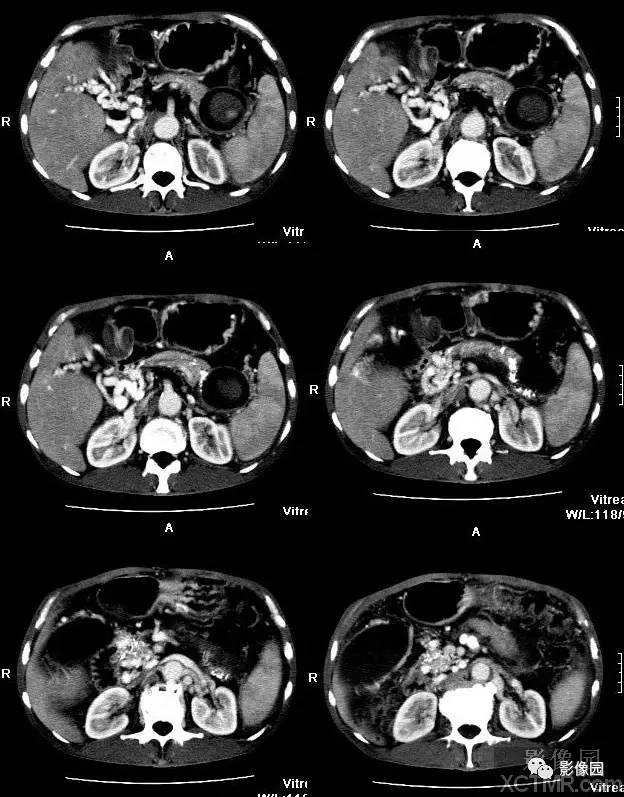 【病例】胰腺假性囊肿并囊内假性动脉瘤形成1例CT 【病例】胰腺假性囊肿并囊内假性动脉瘤形成1例CT