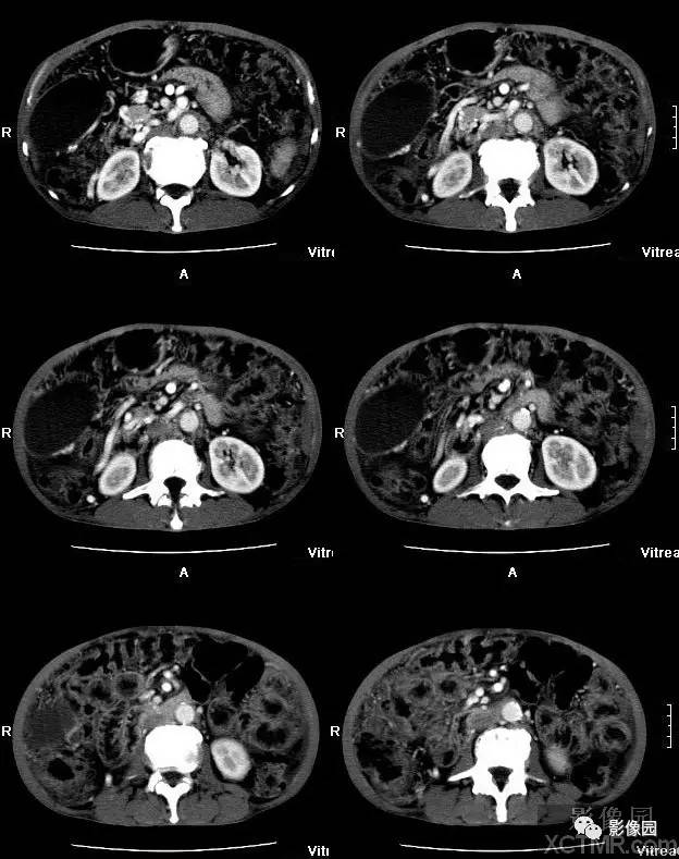 【病例】胰腺假性囊肿并囊内假性动脉瘤形成1例CT 【病例】胰腺假性囊肿并囊内假性动脉瘤形成1例CT