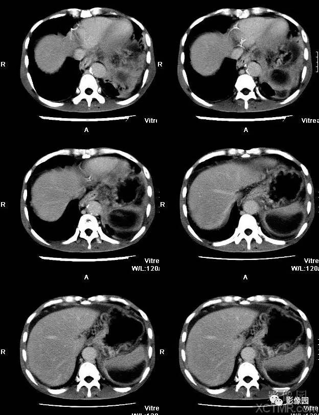 【病例】胰腺假性囊肿并囊内假性动脉瘤形成1例CT 【病例】胰腺假性囊肿并囊内假性动脉瘤形成1例CT