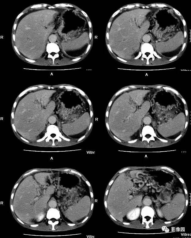 【病例】胰腺假性囊肿并囊内假性动脉瘤形成1例CT 【病例】胰腺假性囊肿并囊内假性动脉瘤形成1例CT