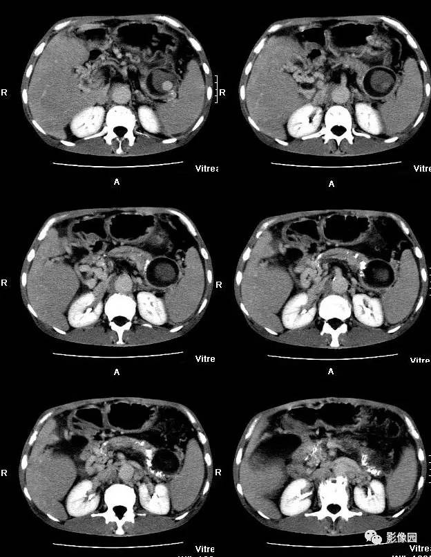 【病例】胰腺假性囊肿并囊内假性动脉瘤形成1例CT 【病例】胰腺假性囊肿并囊内假性动脉瘤形成1例CT