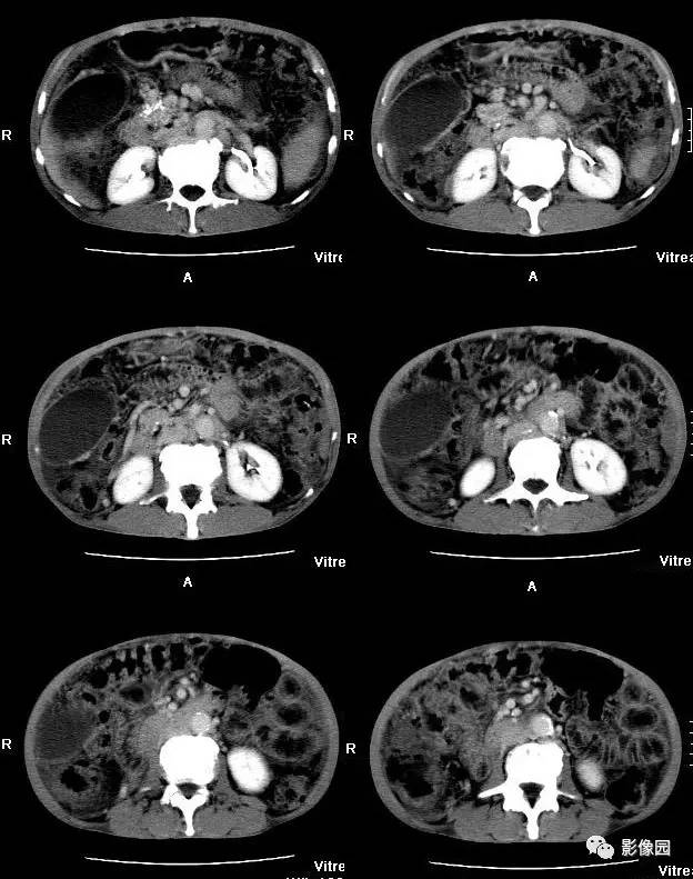 【病例】胰腺假性囊肿并囊内假性动脉瘤形成1例CT 【病例】胰腺假性囊肿并囊内假性动脉瘤形成1例CT