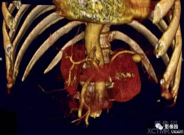 【病例】胰腺假性囊肿并囊内假性动脉瘤形成1例CT 【病例】胰腺假性囊肿并囊内假性动脉瘤形成1例CT