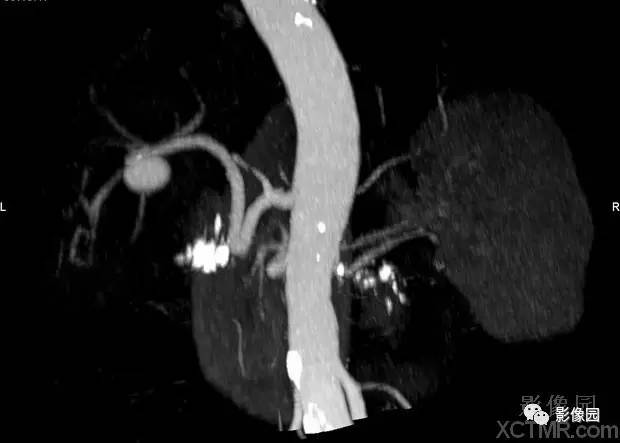 【病例】胰腺假性囊肿并囊内假性动脉瘤形成1例CT 【病例】胰腺假性囊肿并囊内假性动脉瘤形成1例CT