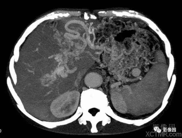 【病例】胰腺假性囊肿并囊内假性动脉瘤形成1例CT