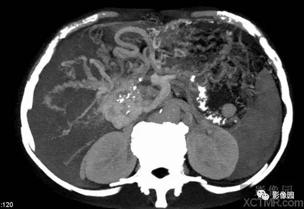 【病例】胰腺假性囊肿并囊内假性动脉瘤形成1例CT 【病例】胰腺假性囊肿并囊内假性动脉瘤形成1例CT