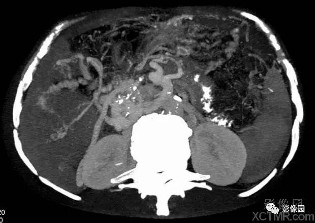 【病例】胰腺假性囊肿并囊内假性动脉瘤形成1例CT 【病例】胰腺假性囊肿并囊内假性动脉瘤形成1例CT