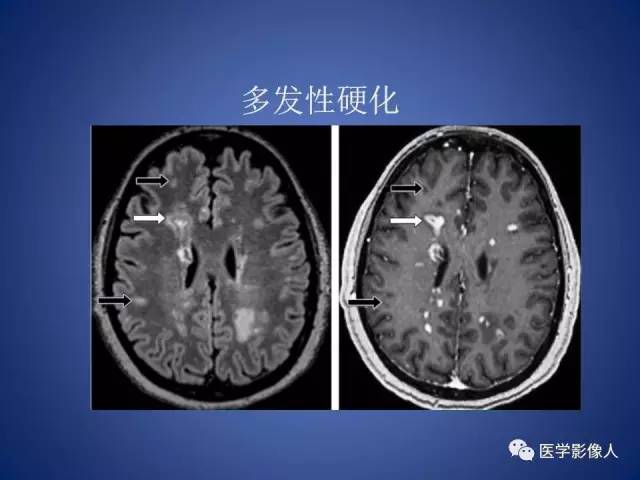 【PPT】脑白质病变的影像学诊断及鉴别诊断