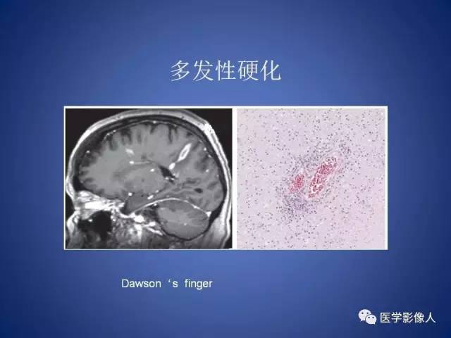 【PPT】脑白质病变的影像学诊断及鉴别诊断