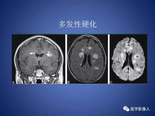 【PPT】脑白质病变的影像学诊断及鉴别诊断