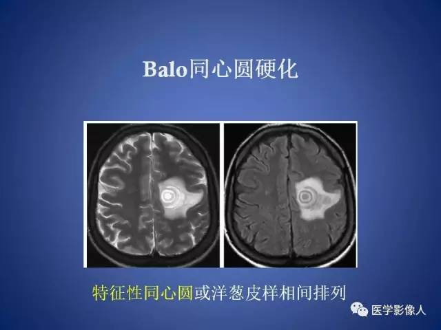 【PPT】脑白质病变的影像学诊断及鉴别诊断