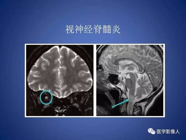 【PPT】脑白质病变的影像学诊断及鉴别诊断