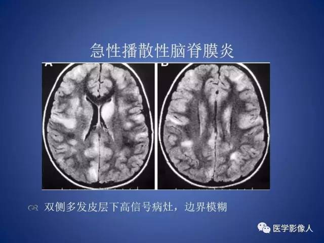 【PPT】脑白质病变的影像学诊断及鉴别诊断