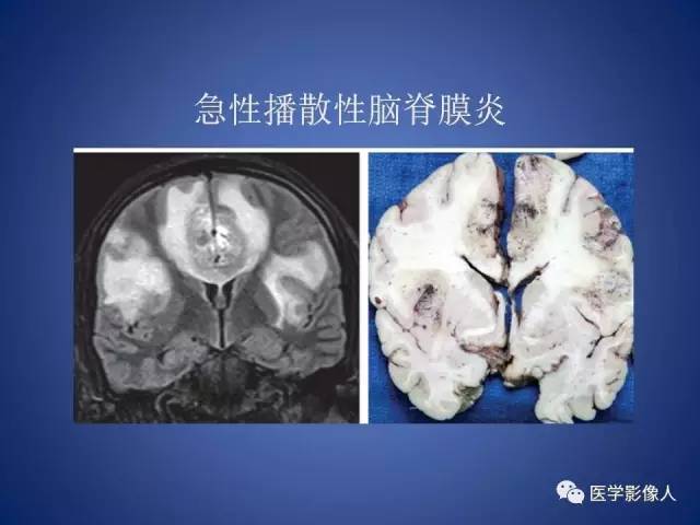 【PPT】脑白质病变的影像学诊断及鉴别诊断