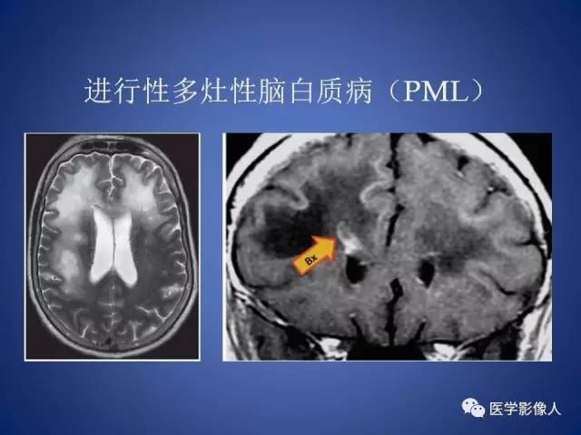 【PPT】脑白质病变的影像学诊断及鉴别诊断