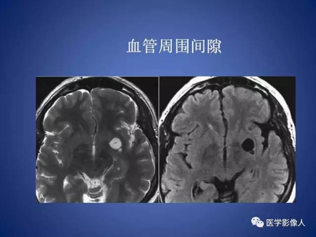【PPT】脑白质病变的影像学诊断及鉴别诊断