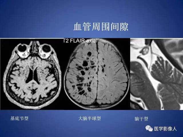 【PPT】脑白质病变的影像学诊断及鉴别诊断