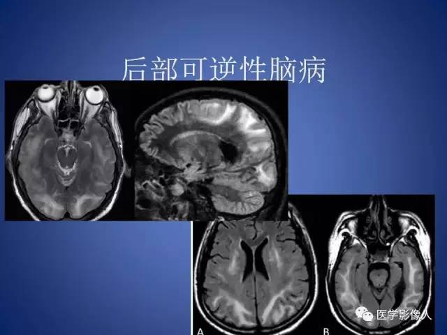 【PPT】脑白质病变的影像学诊断及鉴别诊断