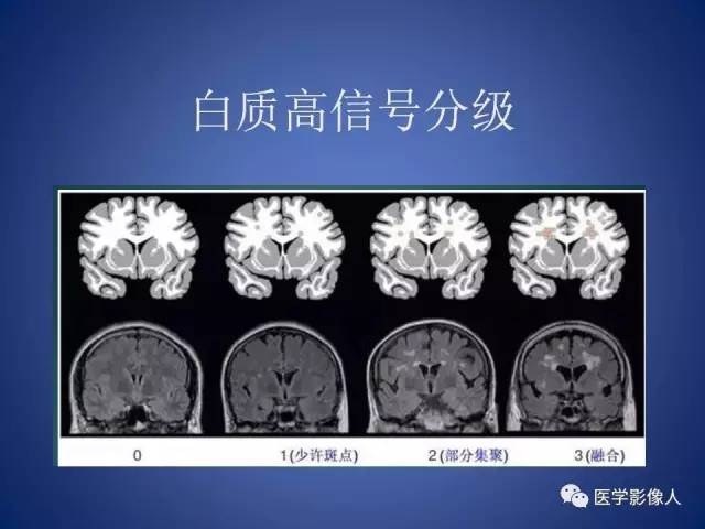【PPT】脑白质病变的影像学诊断及鉴别诊断
