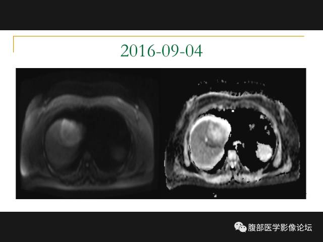 【病例】肝胆管细胞癌1例MR影像表现 【病例】肝胆管细胞癌1例MR影像表现