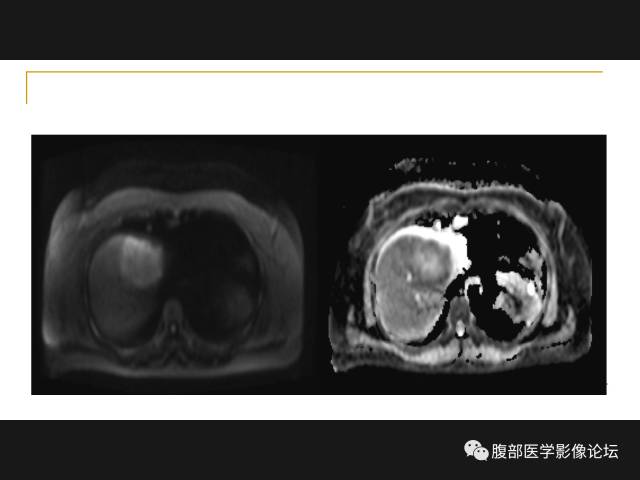 【病例】肝胆管细胞癌1例MR影像表现 【病例】肝胆管细胞癌1例MR影像表现