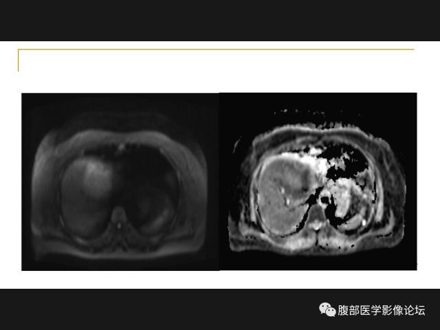 【病例】肝胆管细胞癌1例MR影像表现 【病例】肝胆管细胞癌1例MR影像表现