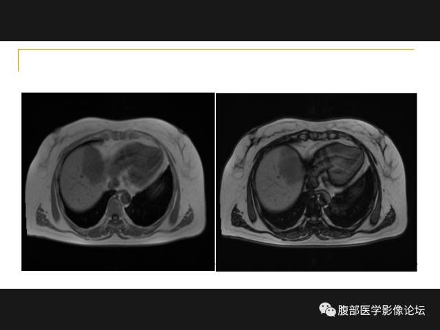 【病例】肝胆管细胞癌1例MR影像表现 【病例】肝胆管细胞癌1例MR影像表现