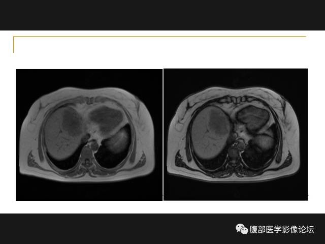 【病例】肝胆管细胞癌1例MR影像表现 【病例】肝胆管细胞癌1例MR影像表现