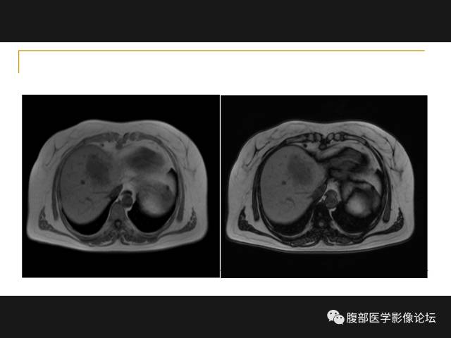 【病例】肝胆管细胞癌1例MR影像表现 【病例】肝胆管细胞癌1例MR影像表现