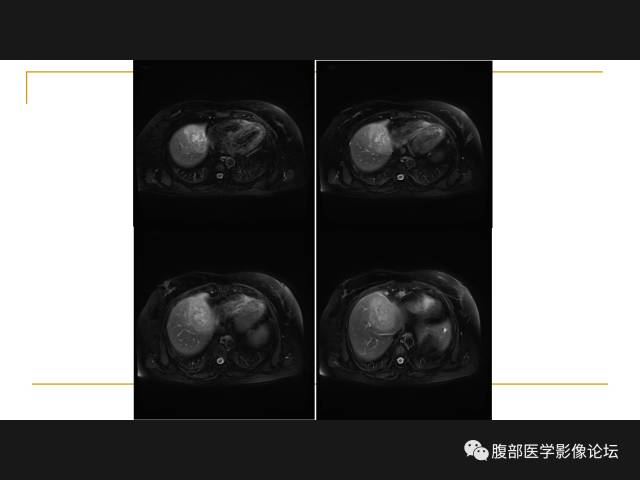 【病例】肝胆管细胞癌1例MR影像表现 【病例】肝胆管细胞癌1例MR影像表现