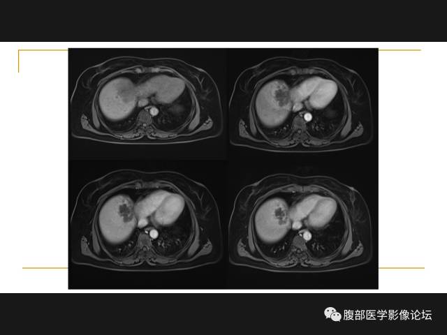 【病例】肝胆管细胞癌1例MR影像表现 【病例】肝胆管细胞癌1例MR影像表现