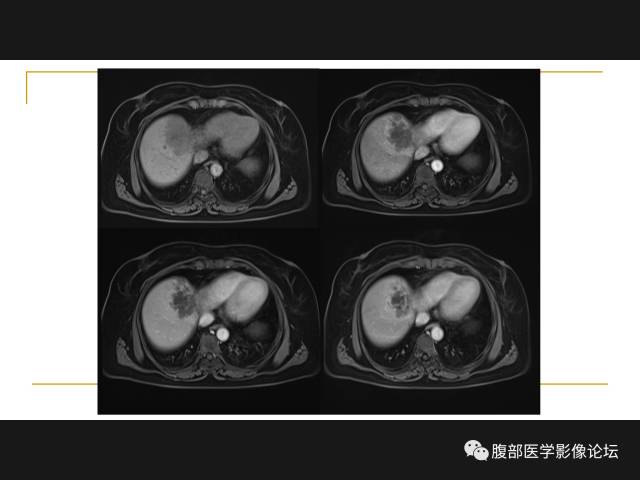 【病例】肝胆管细胞癌1例MR影像表现 【病例】肝胆管细胞癌1例MR影像表现