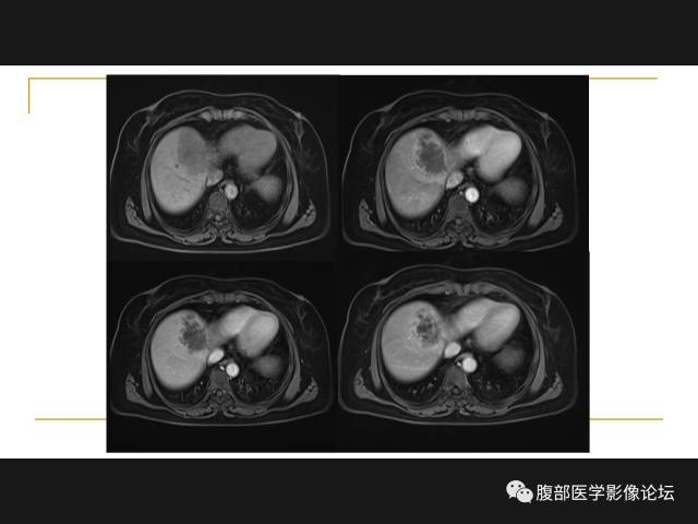 【病例】肝胆管细胞癌1例MR影像表现 【病例】肝胆管细胞癌1例MR影像表现