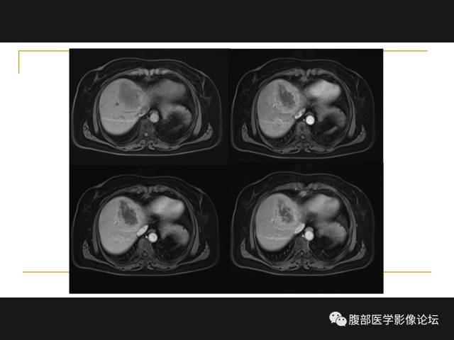 【病例】肝胆管细胞癌1例MR影像表现 【病例】肝胆管细胞癌1例MR影像表现