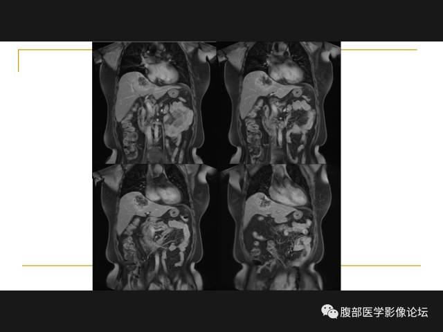 【病例】肝胆管细胞癌1例MR影像表现 【病例】肝胆管细胞癌1例MR影像表现