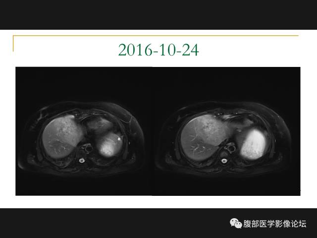 【病例】肝胆管细胞癌1例MR影像表现 【病例】肝胆管细胞癌1例MR影像表现
