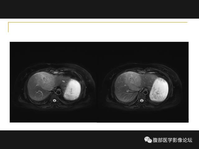【病例】肝胆管细胞癌1例MR影像表现 【病例】肝胆管细胞癌1例MR影像表现