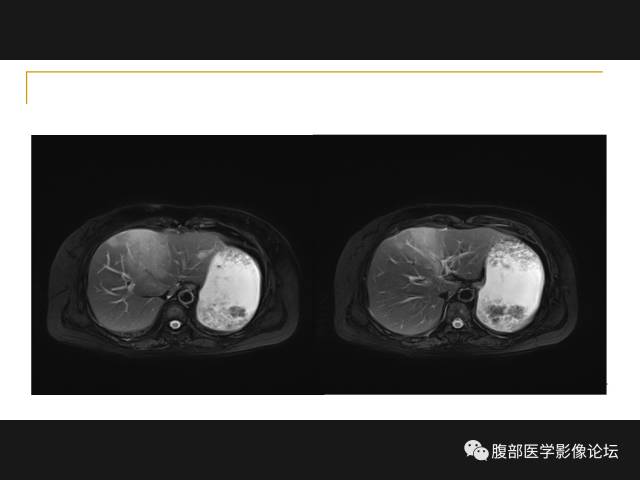 【病例】肝胆管细胞癌1例MR影像表现 【病例】肝胆管细胞癌1例MR影像表现