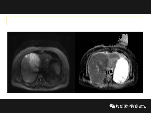 【病例】肝胆管细胞癌1例MR影像表现 【病例】肝胆管细胞癌1例MR影像表现