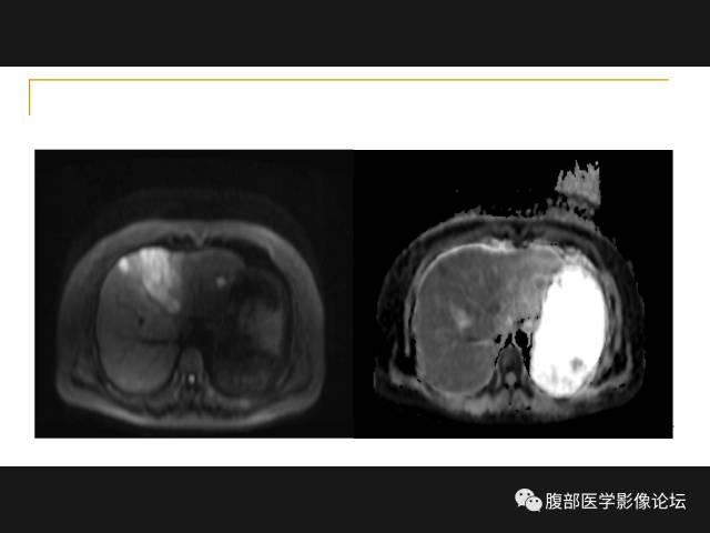 【病例】肝胆管细胞癌1例MR影像表现 【病例】肝胆管细胞癌1例MR影像表现