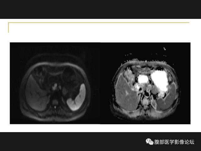 【病例】肝胆管细胞癌1例MR影像表现 【病例】肝胆管细胞癌1例MR影像表现