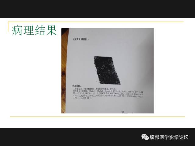 【病例】肝胆管细胞癌1例MR影像表现 【病例】肝胆管细胞癌1例MR影像表现