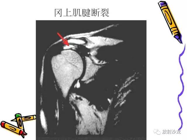 【PPT】肩关节常见创伤性病变