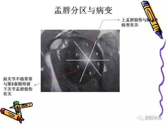【PPT】肩关节常见创伤性病变