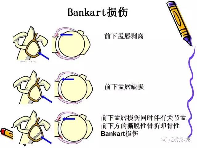 【PPT】肩关节常见创伤性病变