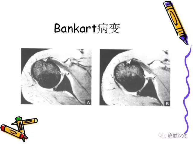 【PPT】肩关节常见创伤性病变