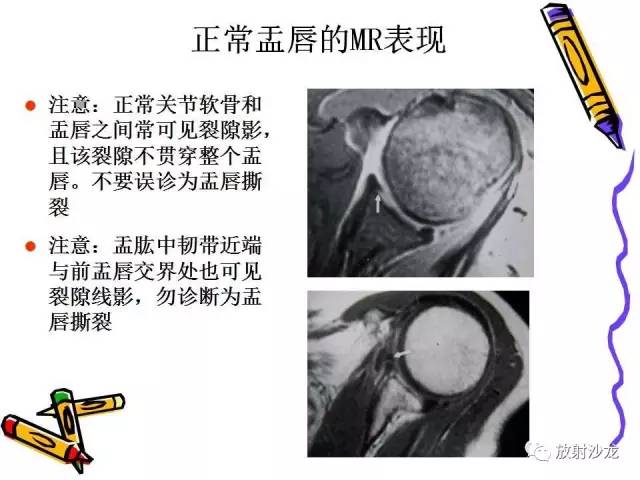 【PPT】肩关节常见创伤性病变