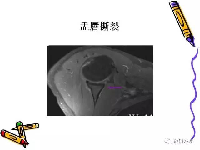 【PPT】肩关节常见创伤性病变
